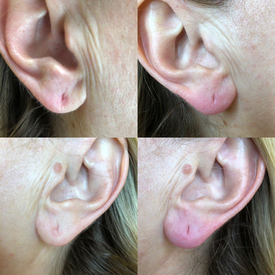 Про восстановление мочек ушей: фото До/После -расскажет клиника PrimaDerm